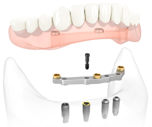 Bridge complet sur implants dentaires All-on-4